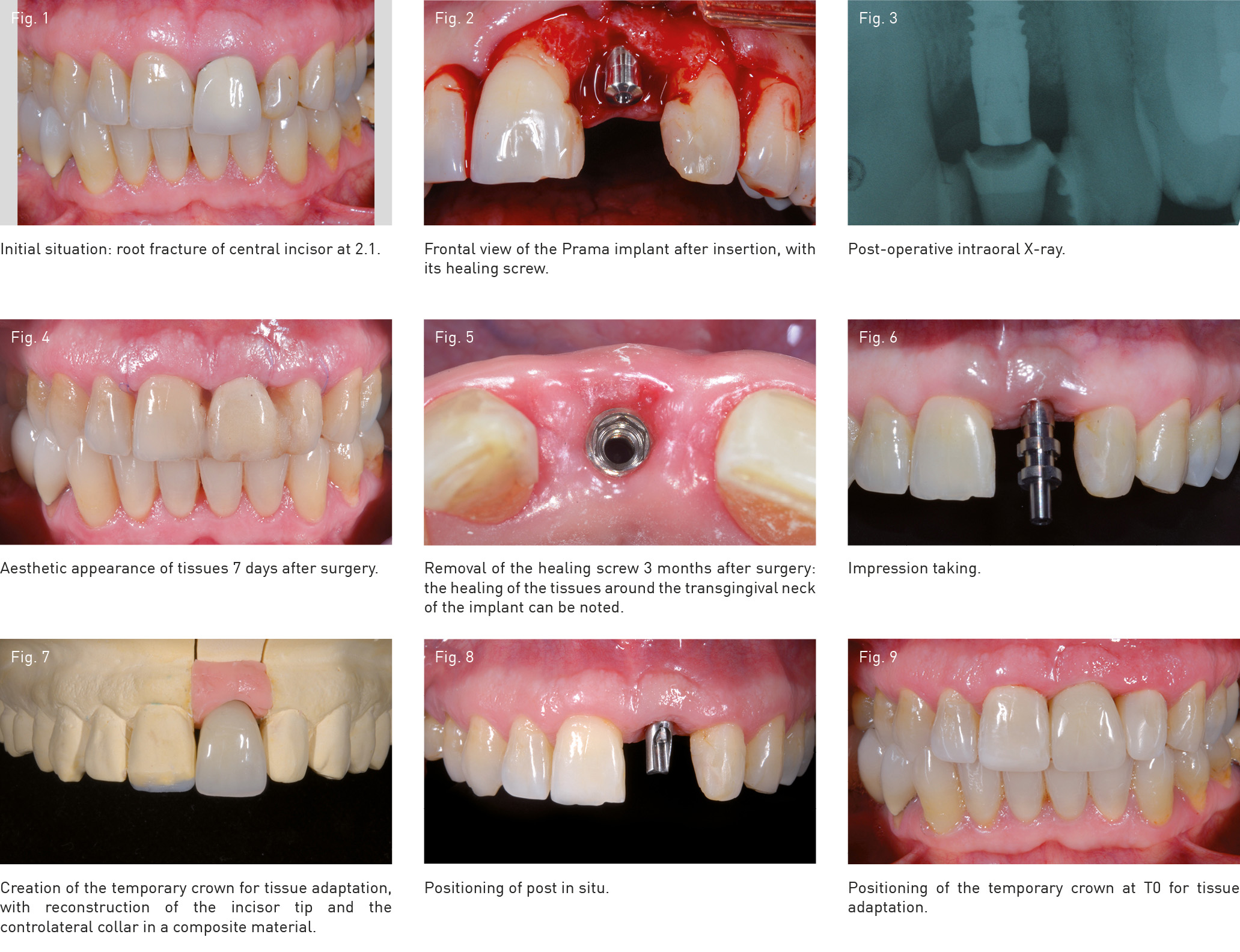 Implantoprosthetic Rehabilitation Of A Frontal Incisor With A Prama ...