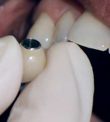 Cementi dentali